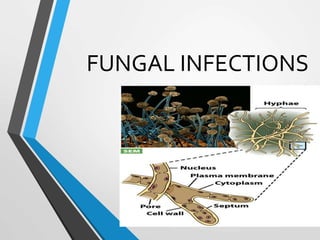 FUNGAL INFECTIONS
 
