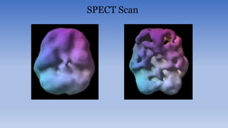 SPECT Scan
 