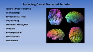 Scalloping/Overall Decreased Perfusion
 Toxicity (drugs or alcohol)
 Chemotherapy
 Environmental toxins
 CO poisoning
 O2 deficit: Anoxia/OSA
 Infection
 Hypothyroidism
 Severe anemia
 Medications
 