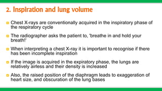Chest X-ray: Basics | PPTX