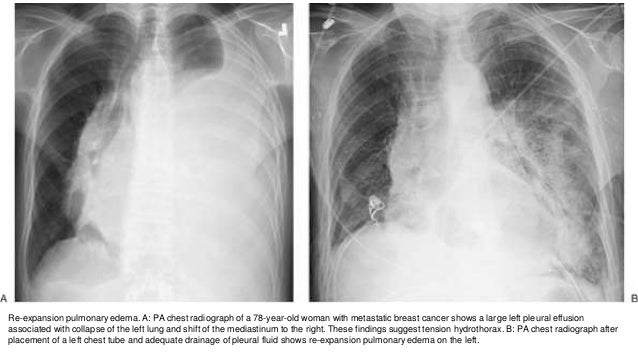 chest x ray basics chest xray