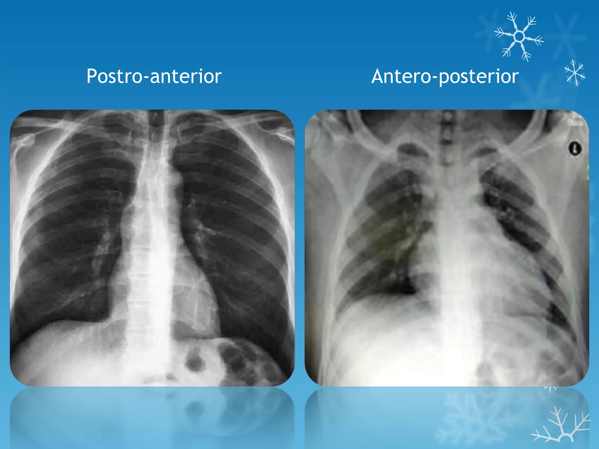 Postro-anterior Antero-posterior