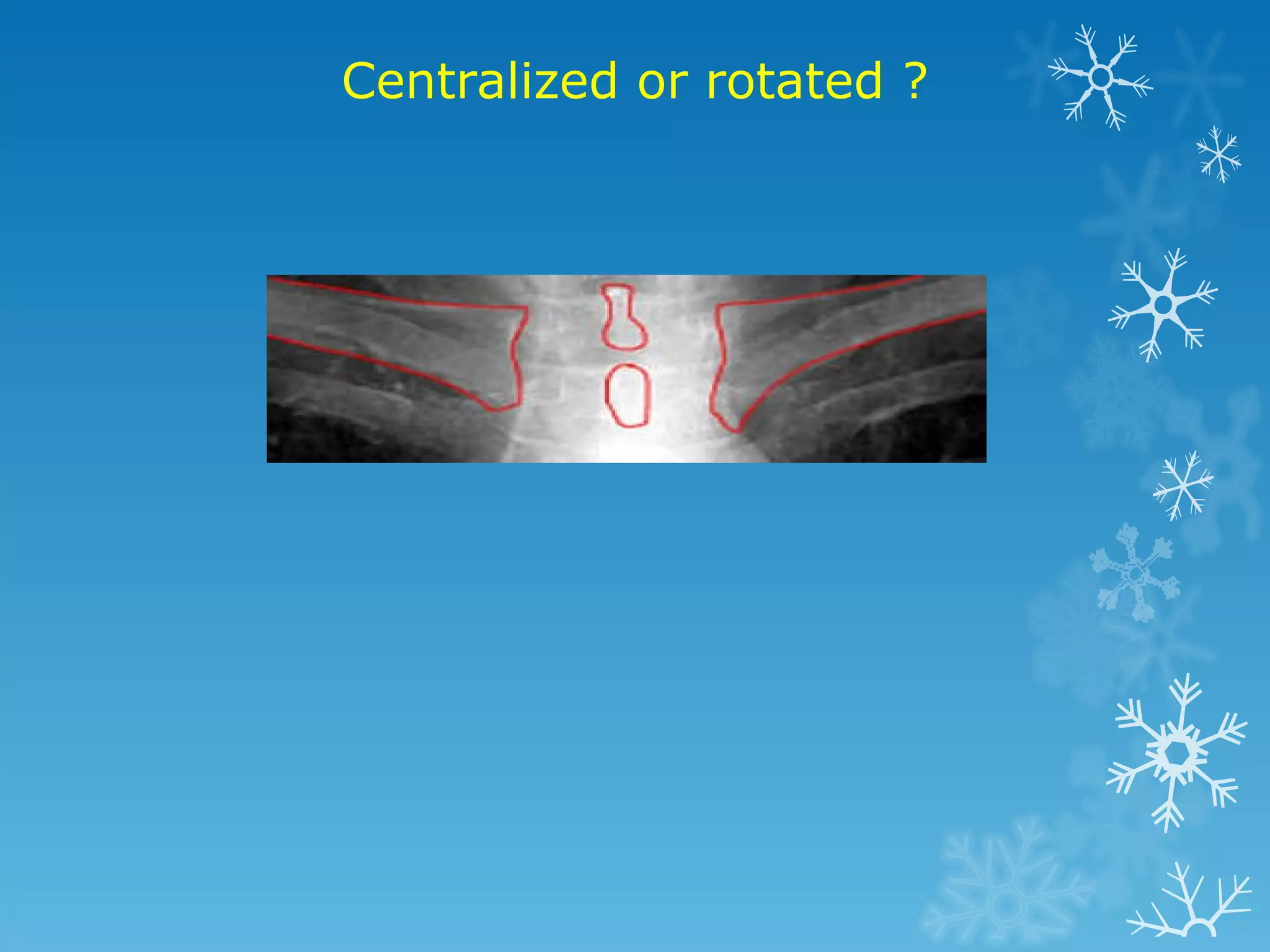Centralized or rotated ?