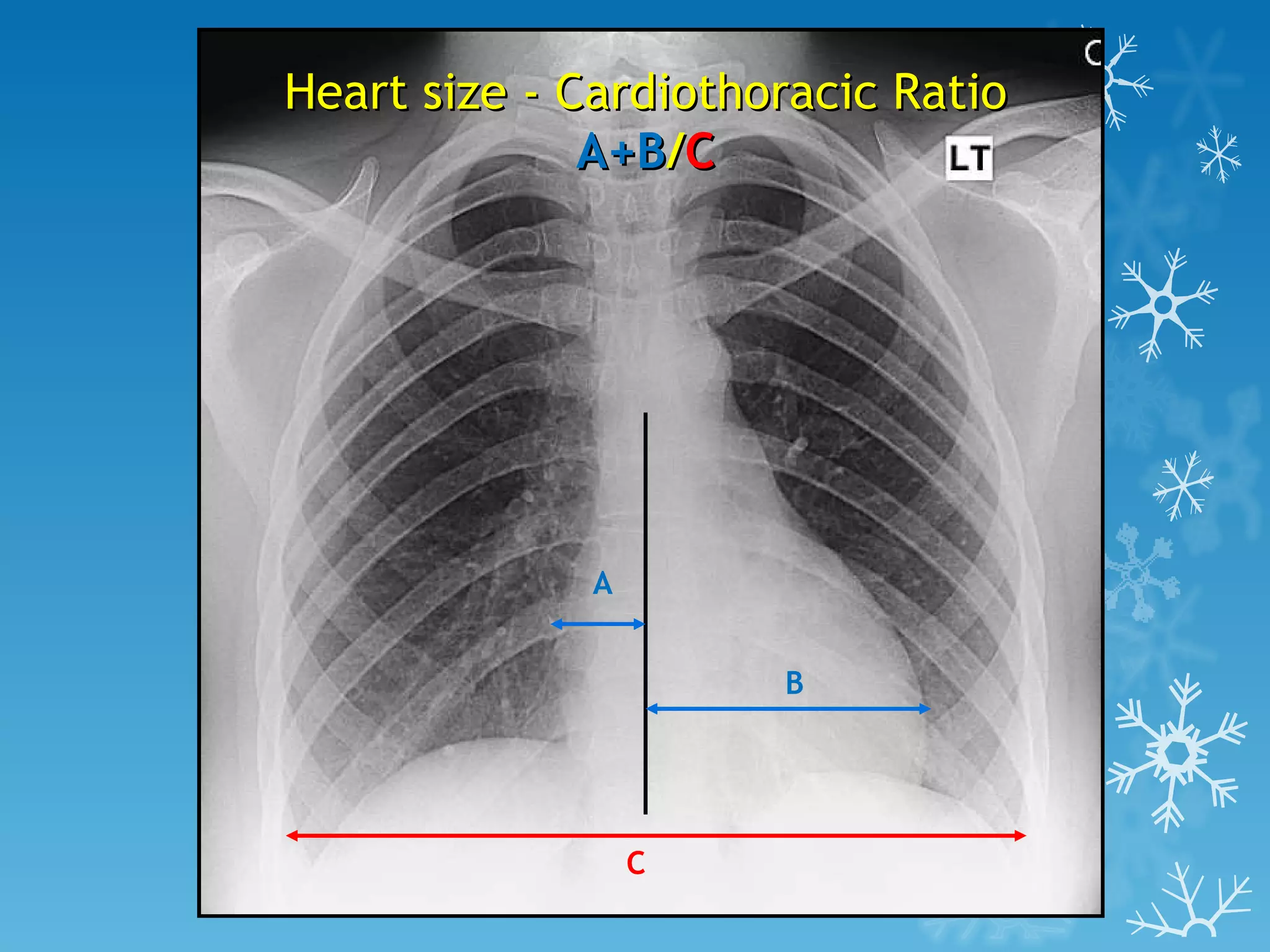 A B C Heart size - Cardiothoracic Ratio A+B / C
