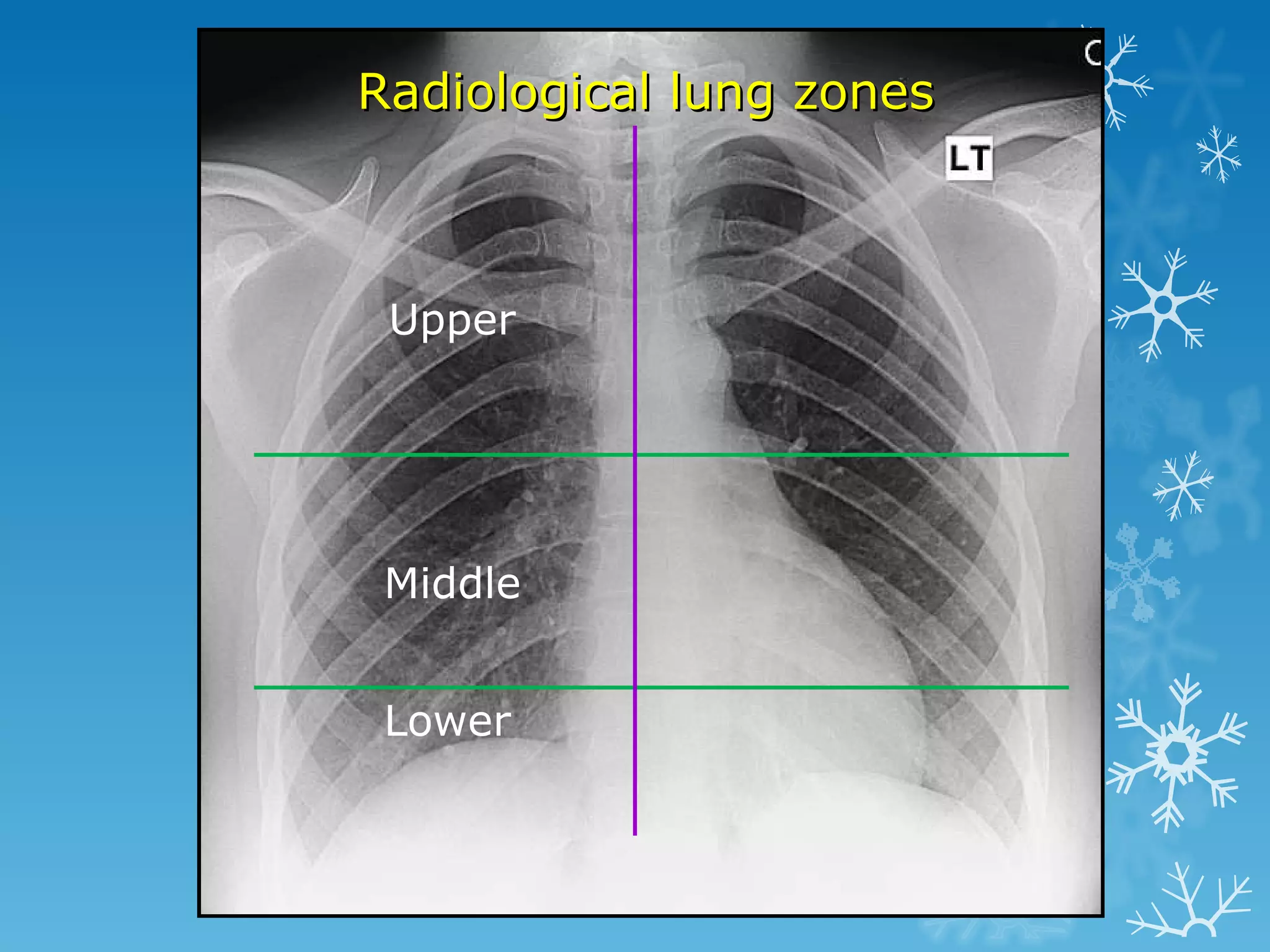 Radiological lung zones Upper Middle Lower