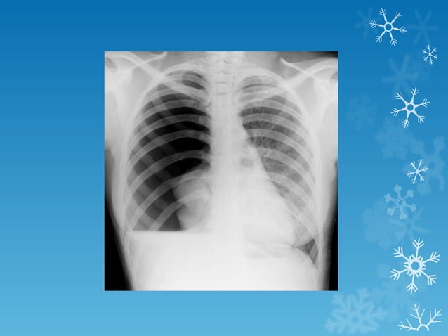 basics of chest X- ray interpretation | PPT | Lung and Respiratory ...