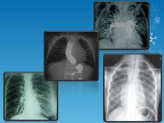 basics of chest X- ray interpretation | PPT