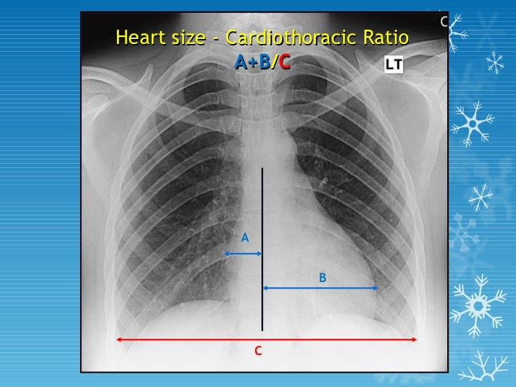 Image result for cardiothoracic ratio
