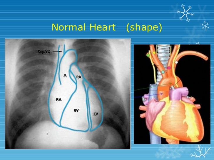basics of chest X ray interpretation
