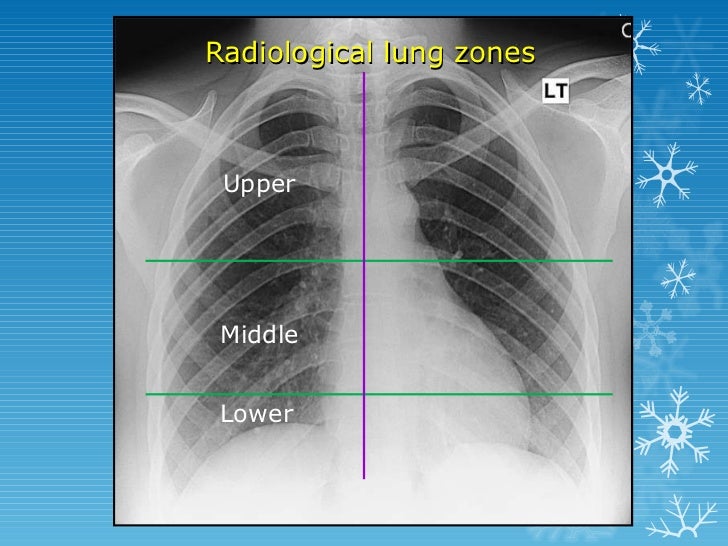 basics of chest X ray interpretation