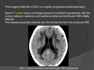 The imaging hallmark of MLD is a rapidly progressive leukodystrophy.
Serial CT scans show centrifugal spread of confluent hypodensity with the
corpus callosum splenium and parietooccipital periventricular WM initially
affected.
The disease gradually extends into the frontal and then the temporal WM.
NECT shows symmetric periventricular WM hypodensity
 