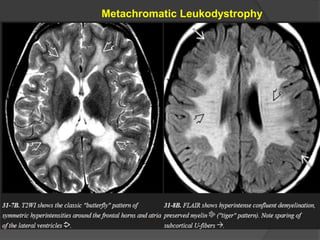 Metachromatic Leukodystrophy
 