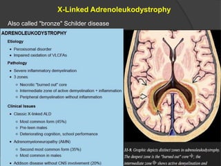 X-Linked Adrenoleukodystrophy
Also called "bronze" Schilder disease
 