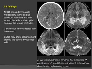 CT findings
NECT scans demonstrate
hypodensity in the corpus
callosum splenium and WM
around the atria and occipital
horns of the lateral ventricles.
Calcification in the affected WM
is common.
CECT may show enhancement
around the central hypodense
WM.
 