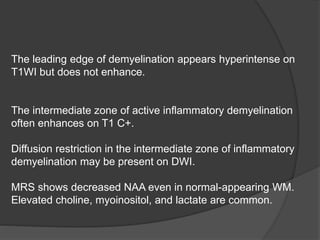 The leading edge of demyelination appears hyperintense on
T1WI but does not enhance.
The intermediate zone of active inflammatory demyelination
often enhances on T1 C+.
Diffusion restriction in the intermediate zone of inflammatory
demyelination may be present on DWI.
MRS shows decreased NAA even in normal-appearing WM.
Elevated choline, myoinositol, and lactate are common.
 