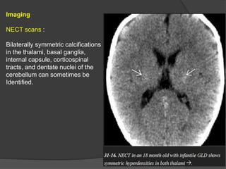 Imaging
NECT scans :
Bilaterally symmetric calcifications
in the thalami, basal ganglia,
internal capsule, corticospinal
tracts, and dentate nuclei of the
cerebellum can sometimes be
Identified.
 