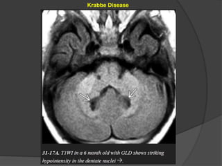 Krabbe Disease
 