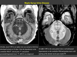 Maple Syrup Urine Disease
 