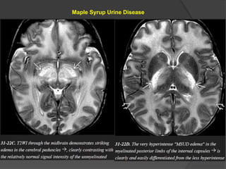 Maple Syrup Urine Disease
 