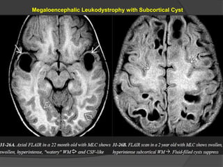 Megaloencephalic Leukodystrophy with Subcortical Cyst
 