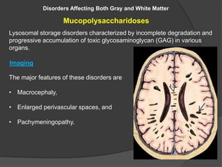 Disorders Affecting Both Gray and White Matter
Mucopolysaccharidoses
Lysosomal storage disorders characterized by incomplete degradation and
progressive accumulation of toxic glycosaminoglycan (GAG) in various
organs.
The major features of these disorders are
• Macrocephaly,
• Enlarged perivascular spaces, and
• Pachymeningopathy.
Imaging
 