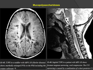 Mucopolysaccharidoses
 