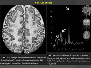 Canavan Disease
 