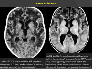 Alexander Disease
 