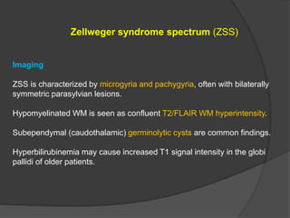 Zellweger syndrome spectrum (ZSS)
Imaging
ZSS is characterized by microgyria and pachygyria, often with bilaterally
symmetric parasylvian lesions.
Hypomyelinated WM is seen as confluent T2/FLAIR WM hyperintensity.
Subependymal (caudothalamic) germinolytic cysts are common findings.
Hyperbilirubinemia may cause increased T1 signal intensity in the globi
pallidi of older patients.
 