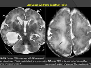 Zellweger syndrome spectrum (ZSS)
 