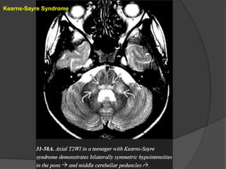 Kearns-Sayre Syndrome
 