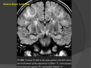Kearns-Sayre Syndrome
 