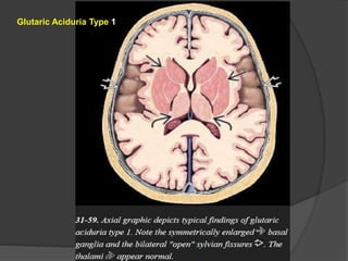 Glutaric Aciduria Type 1
 
