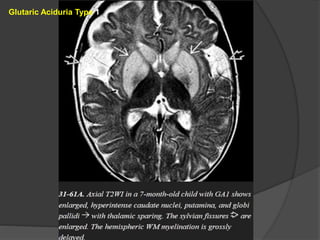 Glutaric Aciduria Type 1
 