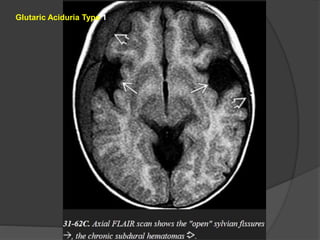 Glutaric Aciduria Type 1
 