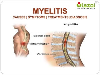 Understanding Myelitis [SOLVED]