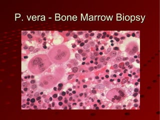 P. vera - Bone Marrow BiopsyP. vera - Bone Marrow Biopsy
 
