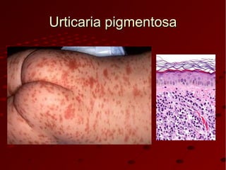 Urticaria pigmentosaUrticaria pigmentosa
 