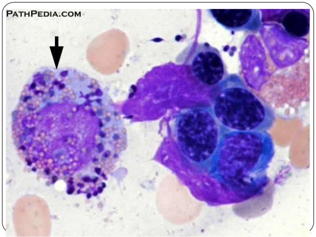Myelodysplastic Syndrome Bone Marrow