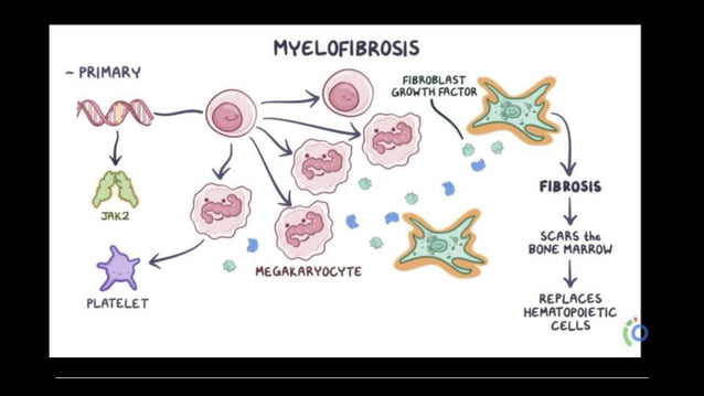 Primary myelofibrosis.pptx | Blood Disorders | Diseases and Conditions