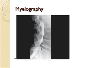 MyelographyMyelography
 