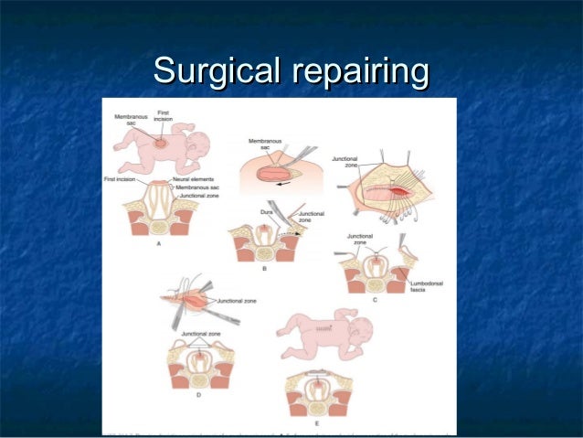 myelomeningocele myelomeningocele repair