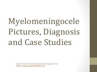 Myelomeningocele
Pictures, Diagnosis
and Case Studies
Learn more about Myelomeningocele at
http://www.spinabifida.net
 