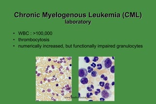 Chronic Myelogenous Leukemia (CML)  laboratory WBC : >100,000 thrombocytosis numerically increased, but functionally impaired granulocytes www.freelivedoctor.com 
