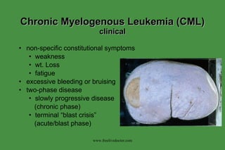 Chronic Myelogenous Leukemia (CML)  clinical non-specific constitutional symptoms weakness wt. Loss fatigue excessive bleeding or bruising two-phase disease slowly progressive disease (chronic phase) terminal “blast crisis” (acute/blast phase) www.freelivedoctor.com 
