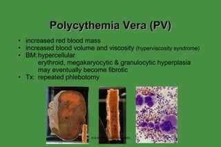 Polycythemia Vera (PV) increased red blood mass increased blood volume and viscosity  (hyperviscosity syndrome) BM: hypercellular erythroid, megakaryocytic & granulocytic hyperplasia may eventually become fibrotic Tx: repeated phlebotomy www.freelivedoctor.com 