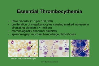 Essential Thrombocythemia Rare disorder (1.5 per 100,000) proliferation of megakaryocytes causing marked increase in circulating platelets (>1 million) morphologically abnormal platelets splenomegaly, mucosal hemorrhage, thromboses arrow: macrothrombocyte www.freelivedoctor.com 