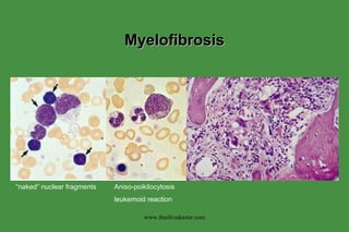 Myelofibrosis Aniso-poikilocytosis leukemoid reaction “ naked” nuclear fragments www.freelivedoctor.com 