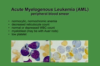 Acute Myelogenous Leukemia (AML)  peripheral blood smear normocytic, normochromic anemia decreased reticulocyte count normal or depressed WBC count myeloblast (may be with Auer rods) low platelet www.freelivedoctor.com 