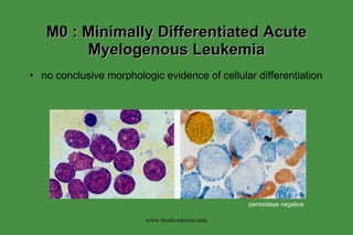 M0 : Minimally Differentiated Acute Myelogenous Leukemia no conclusive morphologic evidence of cellular differentiation www.freelivedoctor.com peroxidase negative 